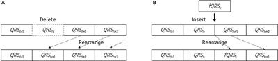 Quantitative Analysis of the Effect of an Ectopic Beat on the Heart Rate Variability in the Resting Condition